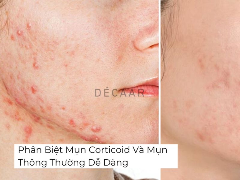 phân biệt mụn do corticoid và mụn thông thường